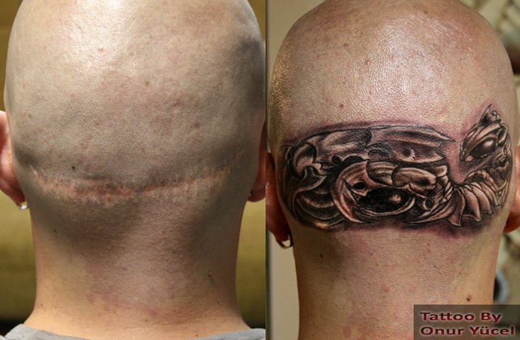 yara izi kapama bio mekanik dövme