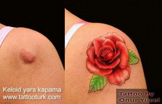 keloid yara kapatma yoketme